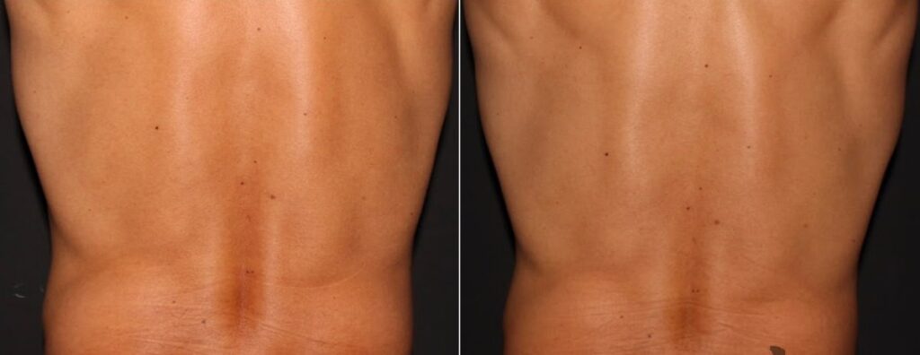 CoolSculpting Before After