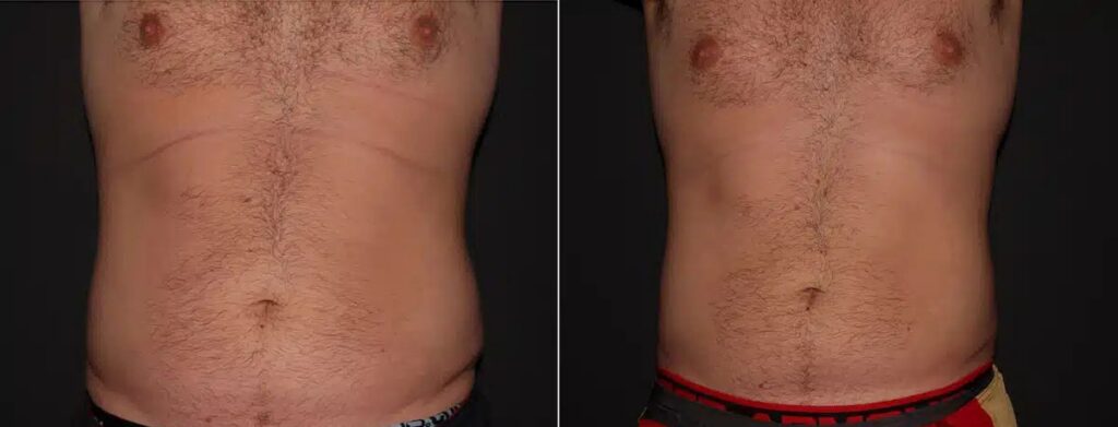 CoolSculpting Before After First