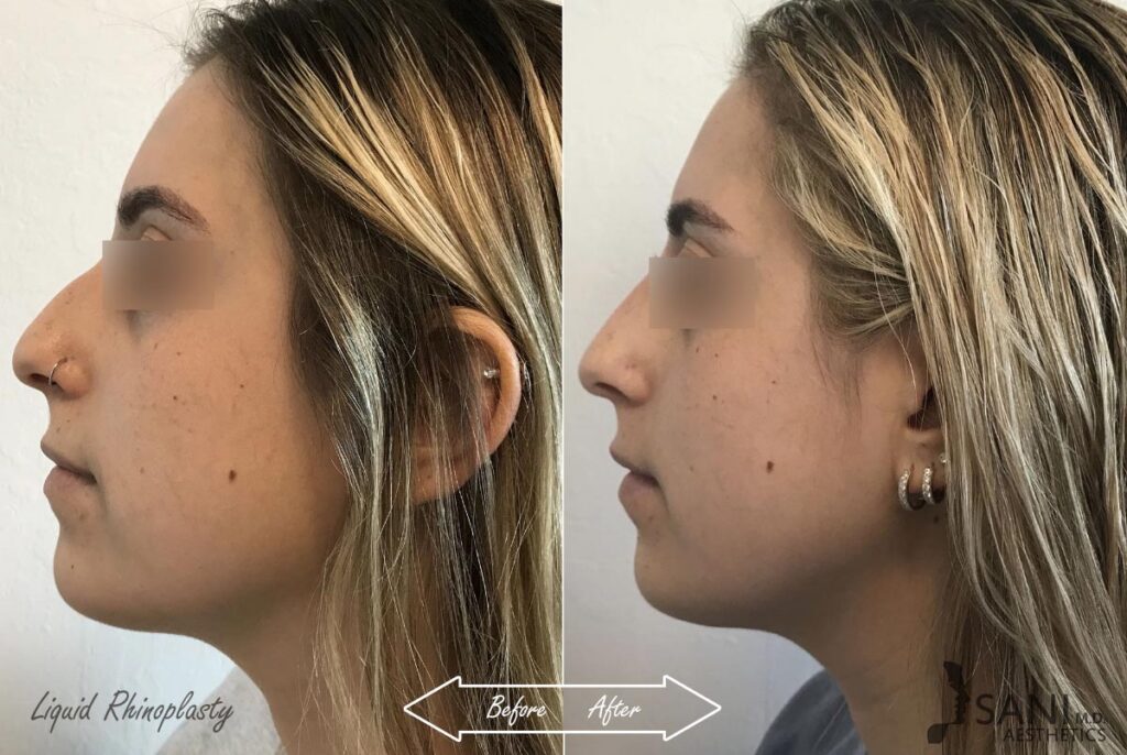 Dermal Fillers Before After