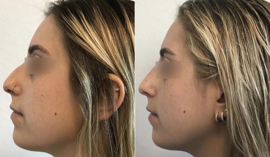 Dermal Fillers Before After