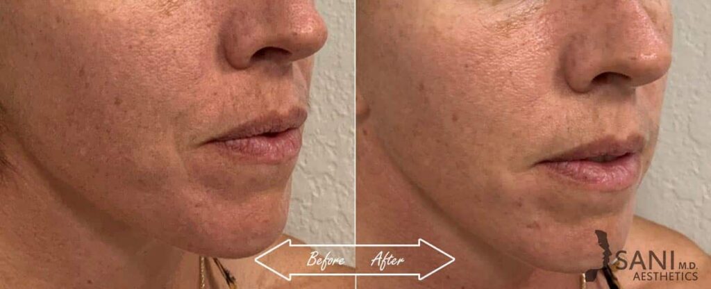 Dermal Fillers Before After