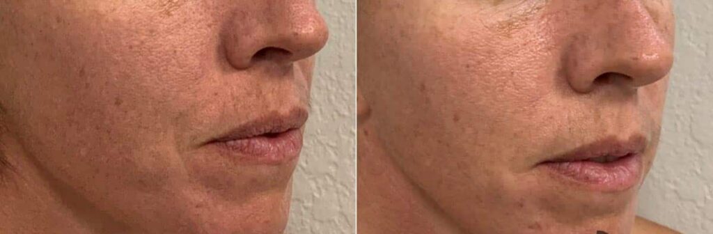 Dermal Fillers Before After