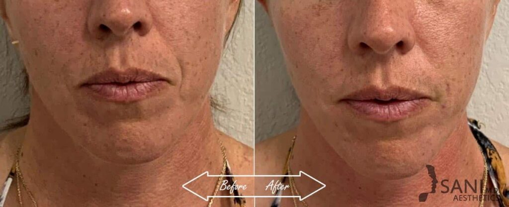 Dermal Fillers Before After