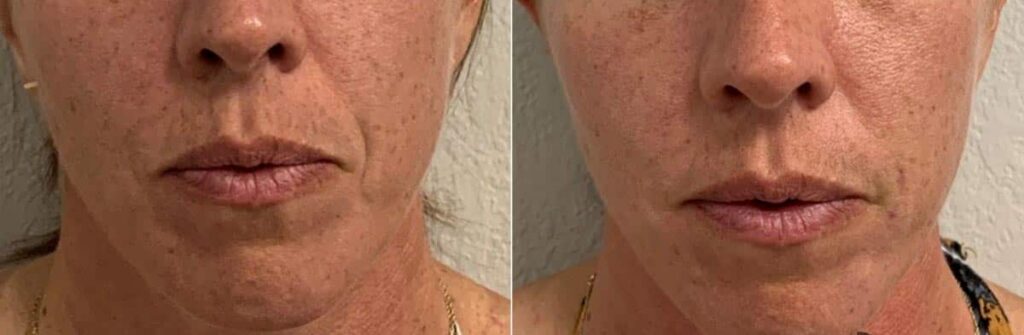 Dermal Fillers Before After