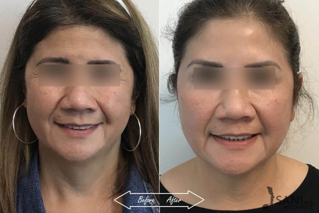 Dermal Fillers Before After