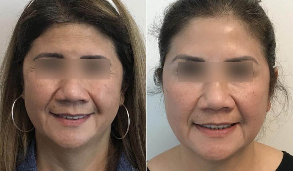 Dermal Fillers Before After
