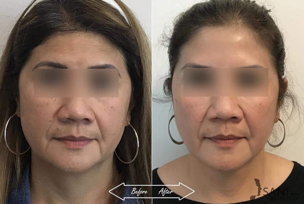 Dermal Fillers Before After