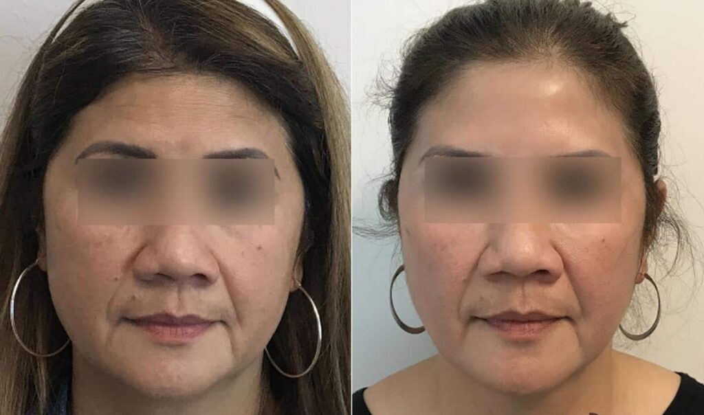 Dermal Fillers Before After