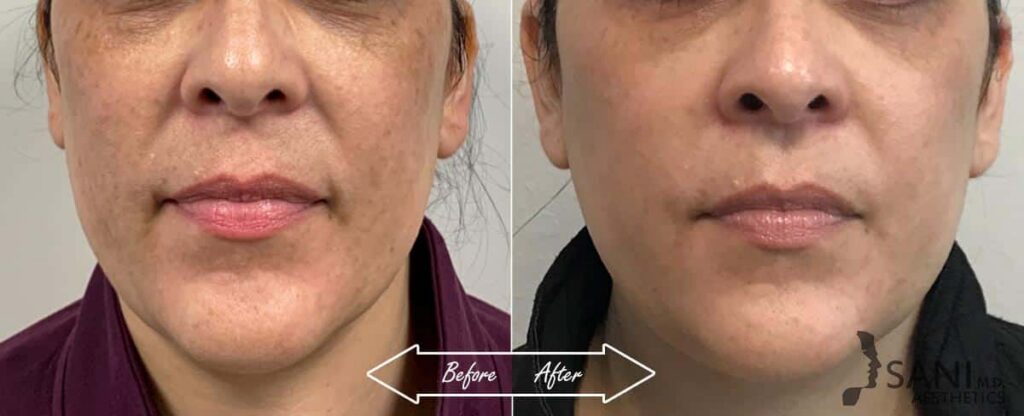 Dermal Fillers Before After