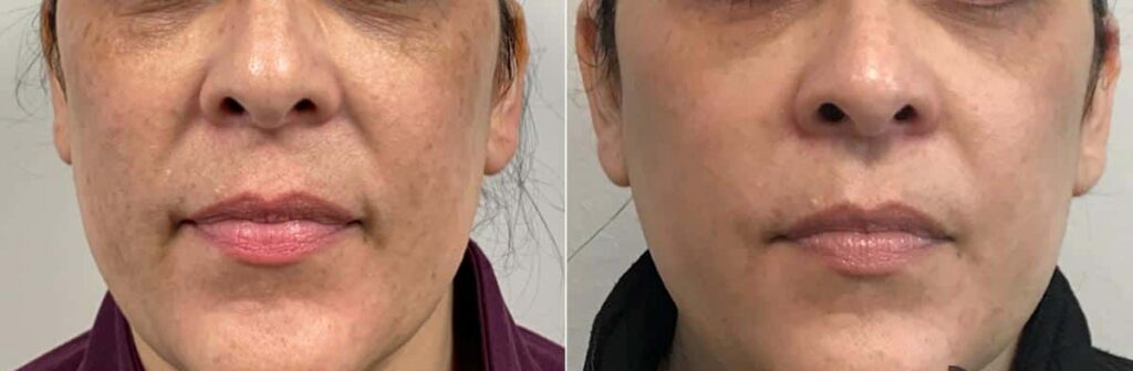 Dermal Fillers Before After
