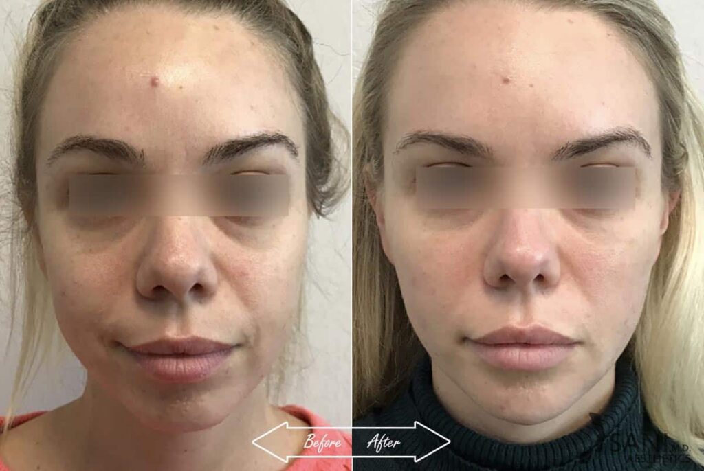 Dermal Fillers Before After