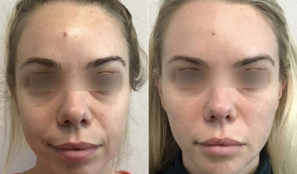 Dermal Fillers Before After