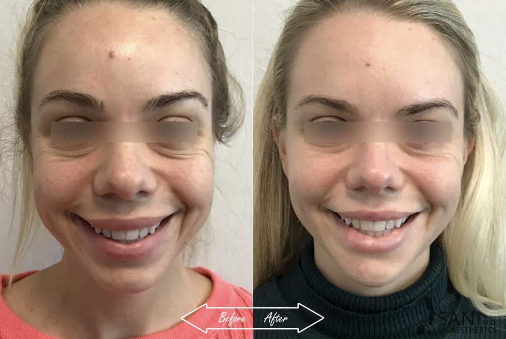 Dermal Fillers Before After