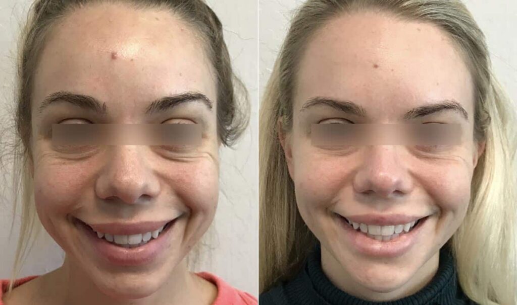 Dermal Fillers Before After