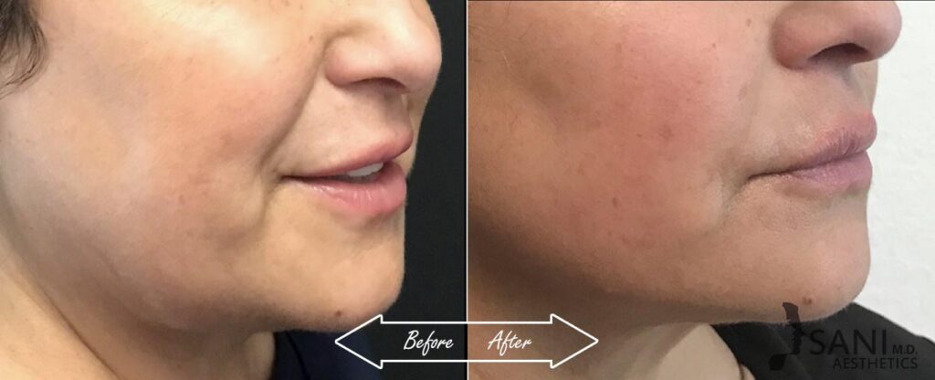 Dermal Fillers Before After