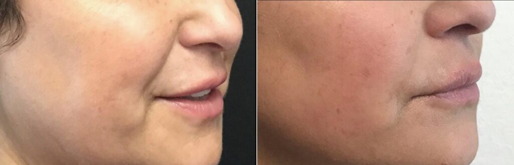 Dermal Fillers Before After
