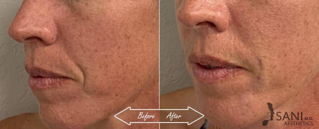 Dermal Fillers Before After First