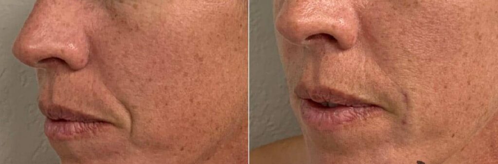 Dermal Fillers Before After First