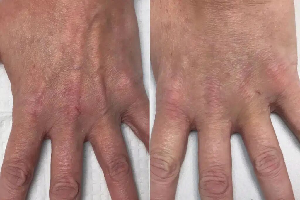 Hand Fullness Filler Before After