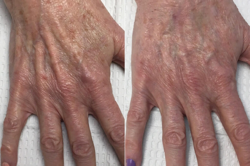 Hand Fullness Filler Before After