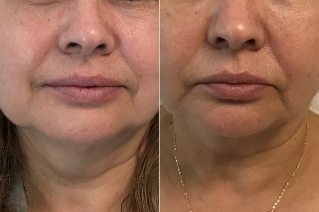 Kybella Before After