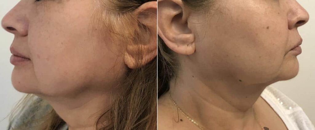 Kybella Before After