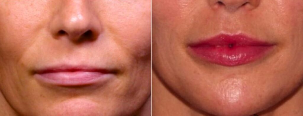 Lip Augmentation Before After