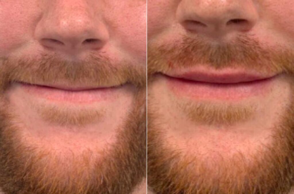 Lip Augmentation Before After