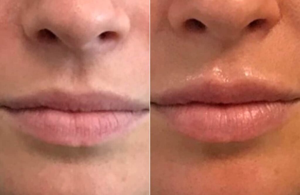 Lip Augmentation Before After