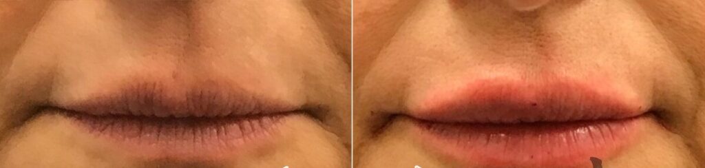 Lip Augmentation Before After