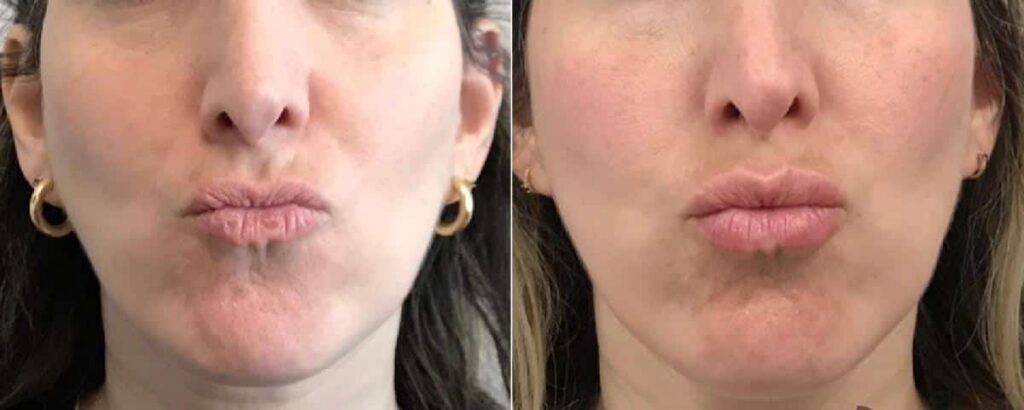 Lip Augmentation Before After