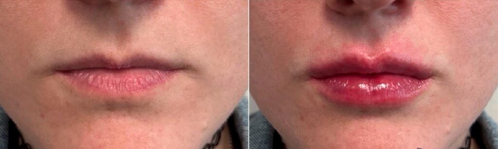 Lip Augmentation Before After