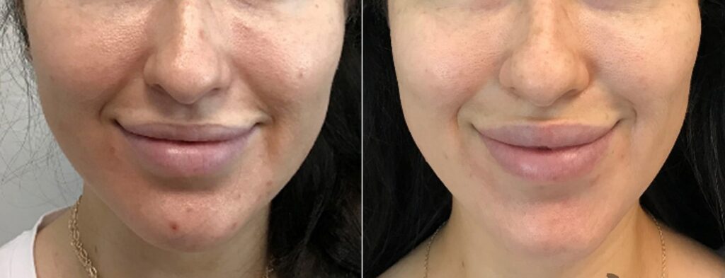 Lip Augmentation Before After First