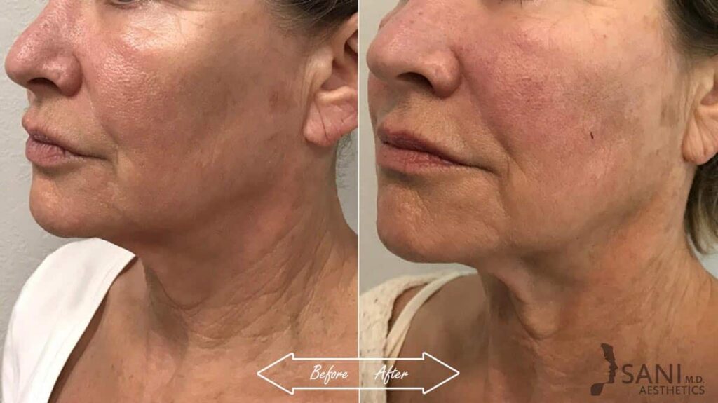 Mid Face Contouring Before After