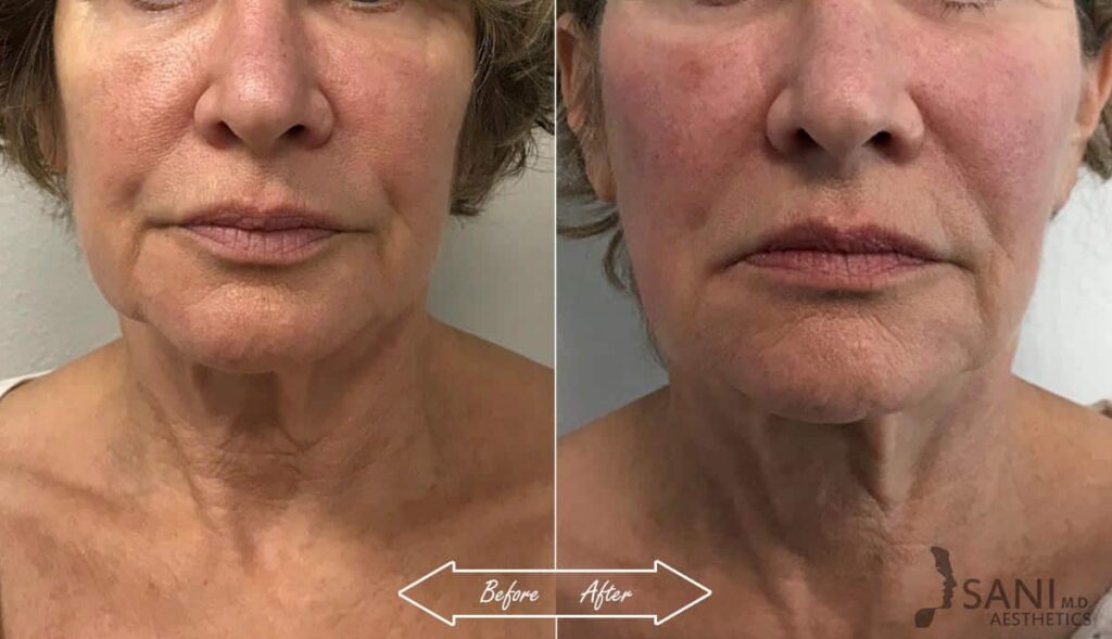 Mid Face Contouring Before After First
