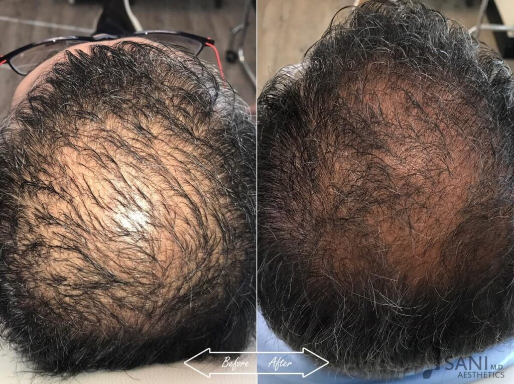 PRP Hair Restoration Before After