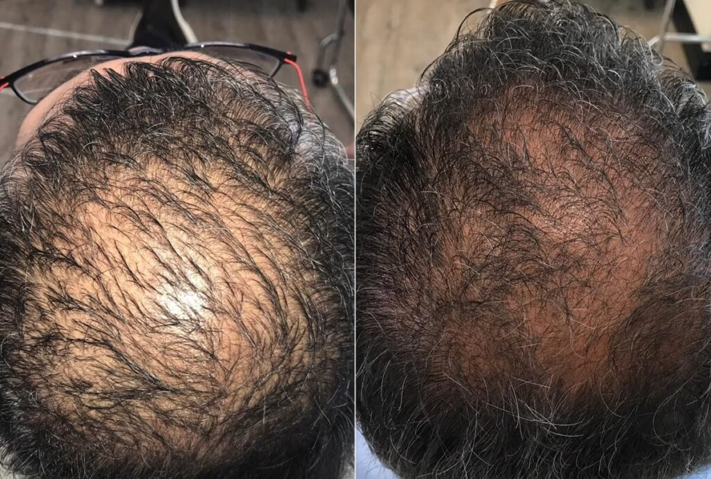 PRP Hair Restoration Before After