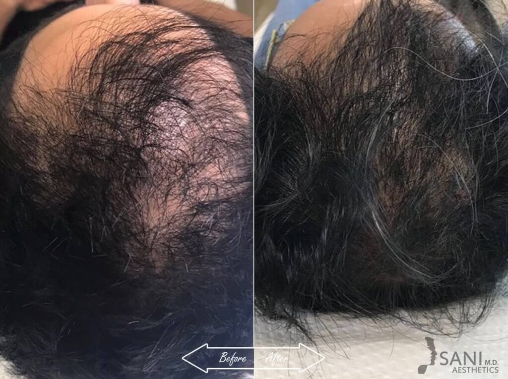 PRP Hair Restoration Before After