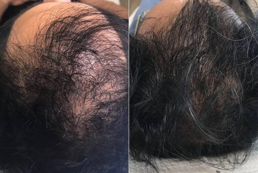 PRP Hair Restoration Before After