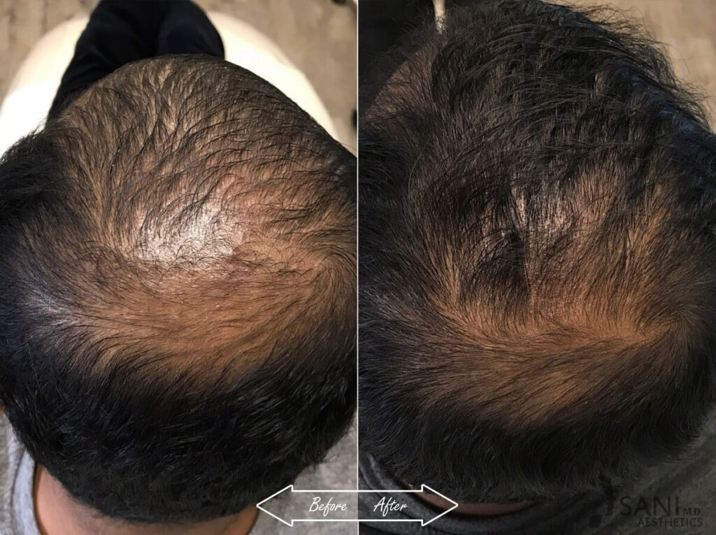 PRP Hair Restoration Before After