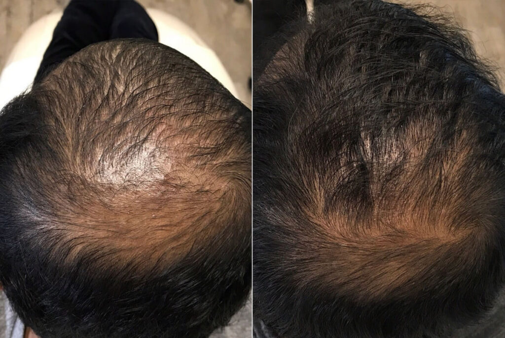PRP Hair Restoration Before After