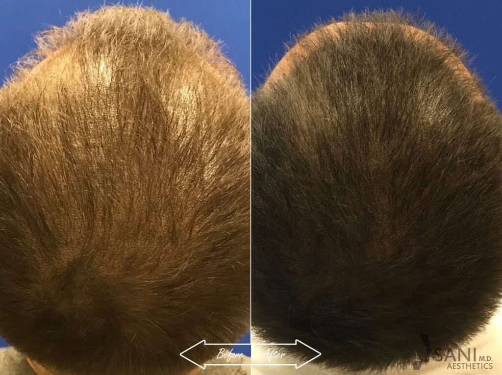 PRP Hair Restoration Before After
