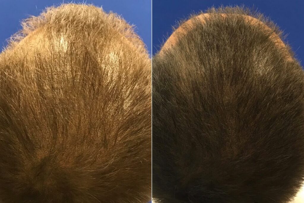 PRP Hair Restoration Before After