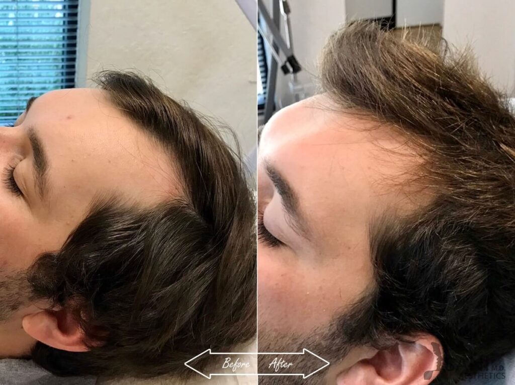 PRP Hair Restoration Before After