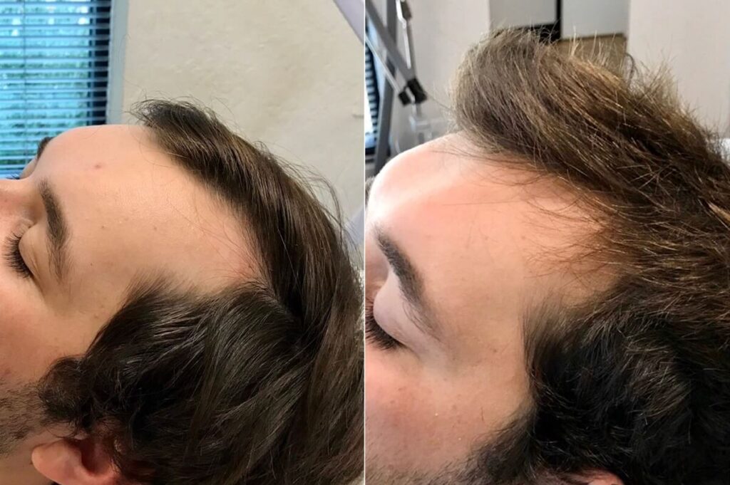 PRP Hair Restoration Before After