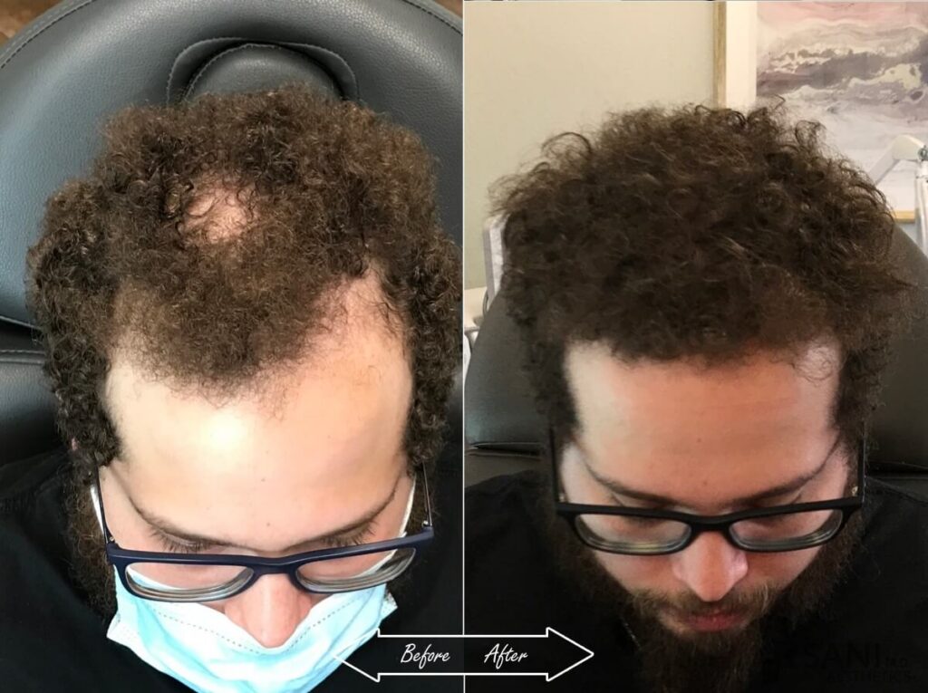 PRP Hair Restoration Before After