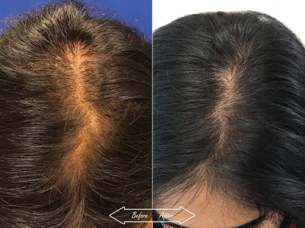 PRP Hair Restoration Before After