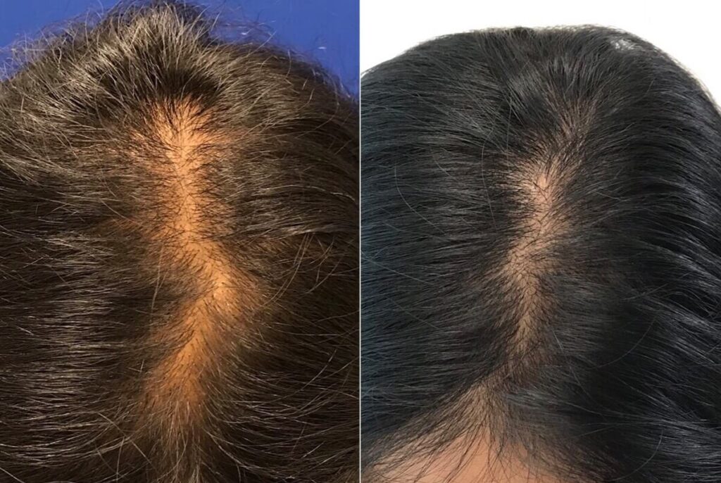 PRP Hair Restoration Before After
