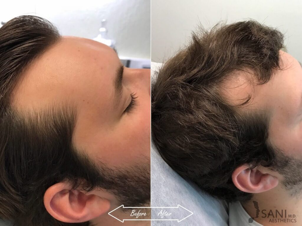 PRP Hair Restoration Before After