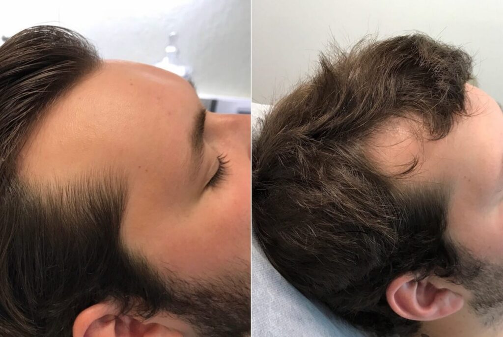 PRP Hair Restoration Before After